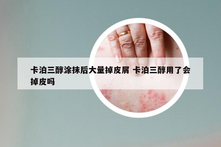 卡泊三醇涂抹后大量掉皮屑 卡泊三醇用了会掉皮吗
