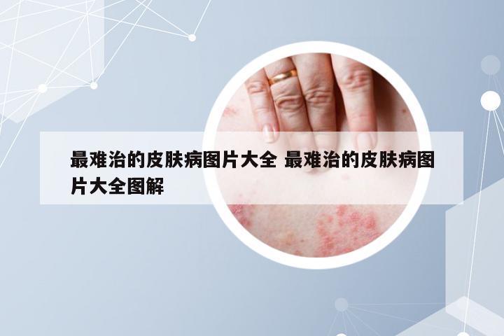 最难治的皮肤病图片大全 最难治的皮肤病图片大全图解