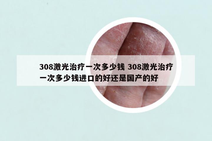 308激光治疗一次多少钱 308激光治疗一次多少钱进口的好还是国产的好