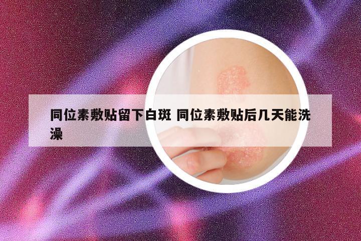 同位素敷贴留下白斑 同位素敷贴后几天能洗澡