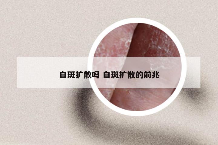 白斑扩散吗 白斑扩散的前兆