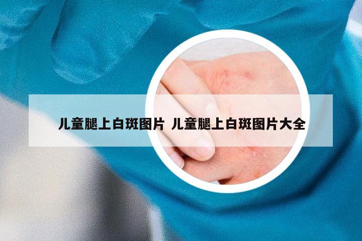 儿童腿上白斑图片 儿童腿上白斑图片大全