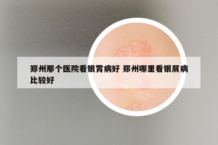 郑州那个医院看银霄病好 郑州哪里看银屑病比较好