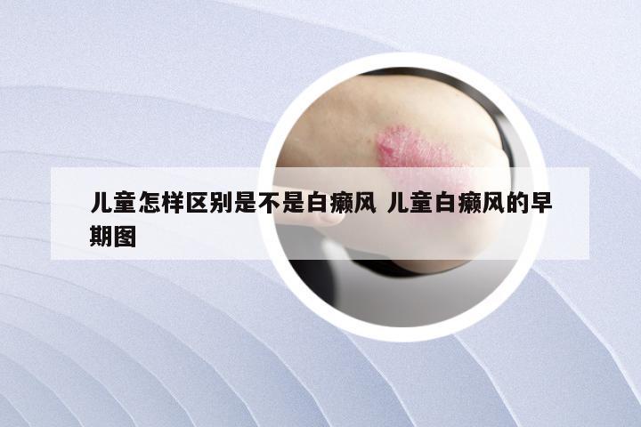 儿童怎样区别是不是白癞风 儿童白癞风的早期图