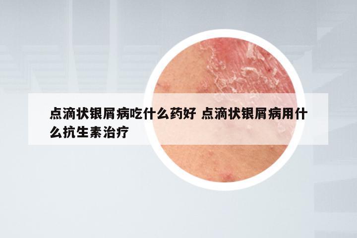 点滴状银屑病吃什么药好 点滴状银屑病用什么抗生素治疗