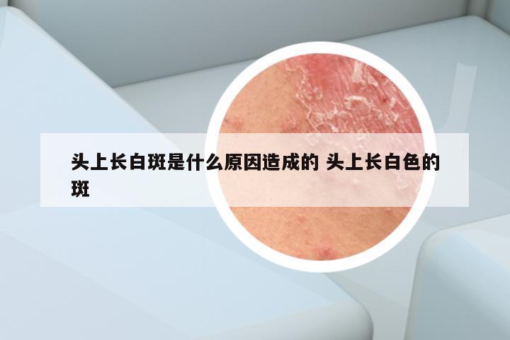 头上长白斑是什么原因造成的 头上长白色的斑