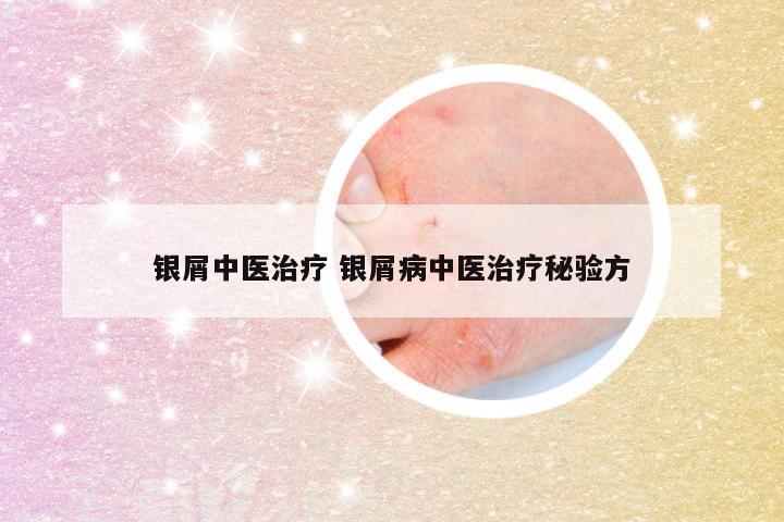 银屑中医治疗 银屑病中医治疗秘验方