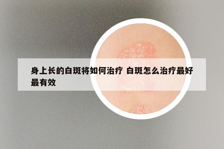 身上长的白斑将如何治疗 白斑怎么治疗最好最有效