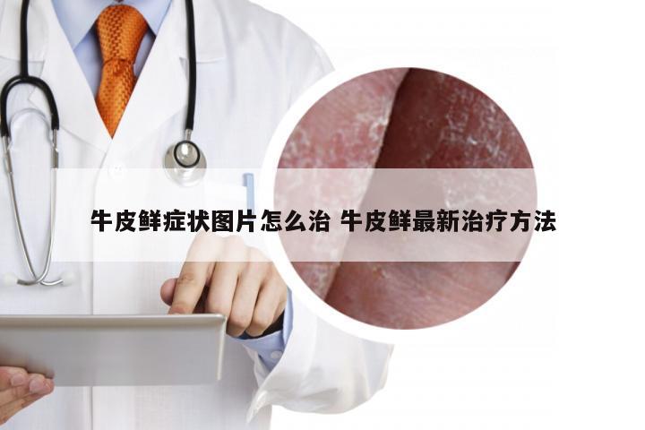 牛皮鲜症状图片怎么治 牛皮鲜最新治疗方法