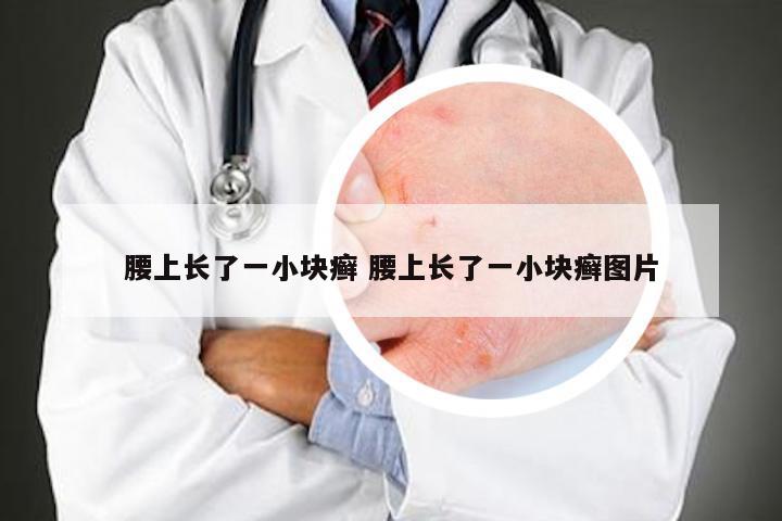 腰上长了一小块癣 腰上长了一小块癣图片