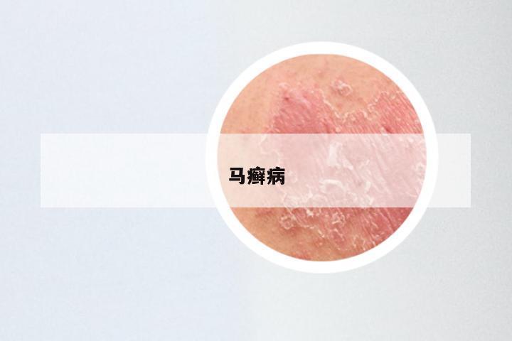 马癣病
