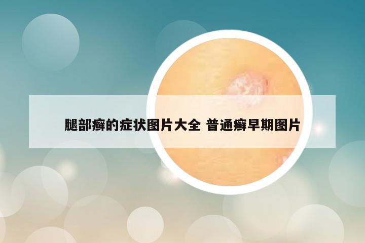 腿部癣的症状图片大全 普通癣早期图片