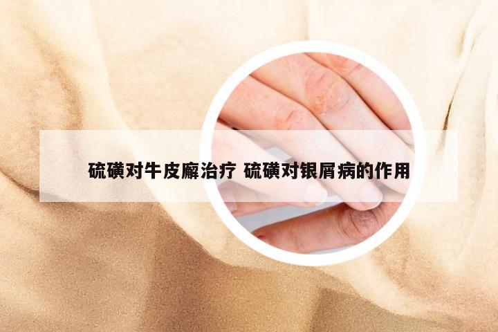 硫磺对牛皮廨治疗 硫磺对银屑病的作用