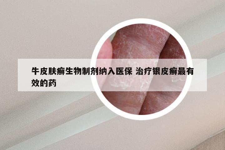牛皮肤癣生物制剂纳入医保 治疗银皮癣最有效的药