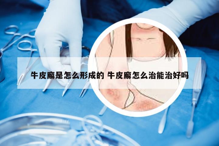 牛皮廨是怎么形成的 牛皮廨怎么治能治好吗