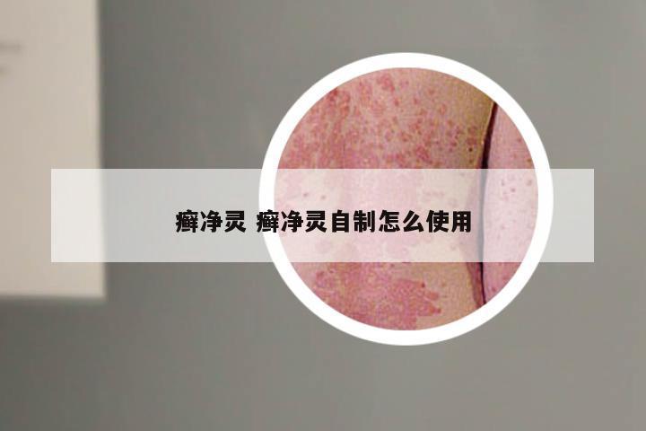 癣净灵 癣净灵自制怎么使用