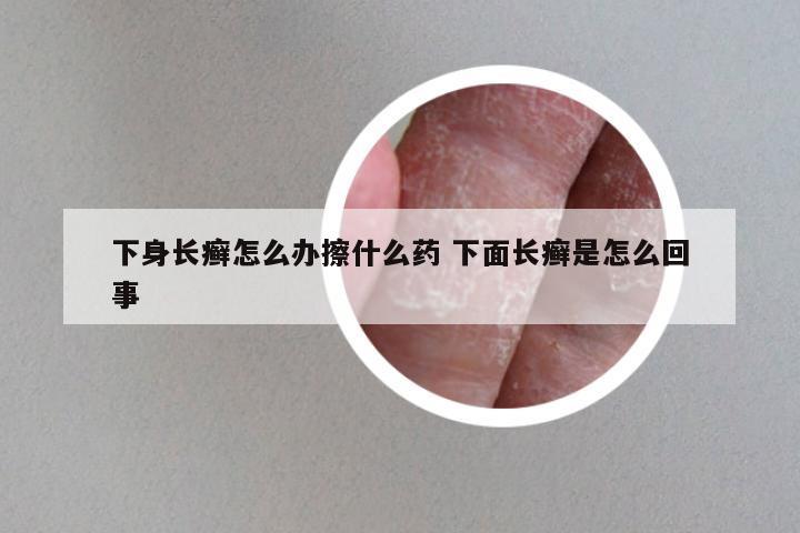 下身长癣怎么办擦什么药 下面长癣是怎么回事