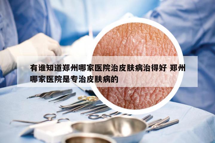 有谁知道郑州哪家医院治皮肤病治得好 郑州哪家医院是专治皮肤病的