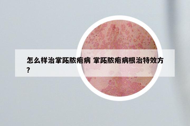 怎么样治掌跖脓疱病 掌跖脓疱病根治特效方?