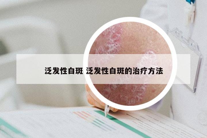 泛发性白斑 泛发性白斑的治疗方法