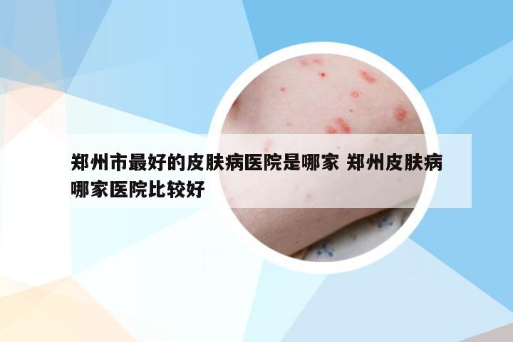 郑州市最好的皮肤病医院是哪家 郑州皮肤病哪家医院比较好
