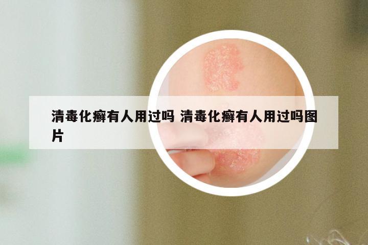 清毒化癣有人用过吗 清毒化癣有人用过吗图片