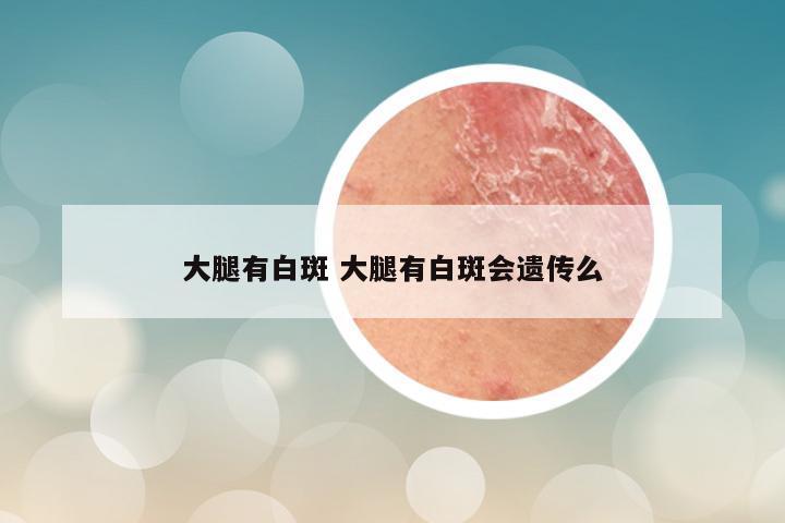 大腿有白斑 大腿有白斑会遗传么