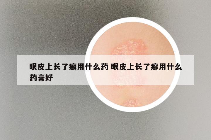 眼皮上长了癣用什么药 眼皮上长了癣用什么药膏好