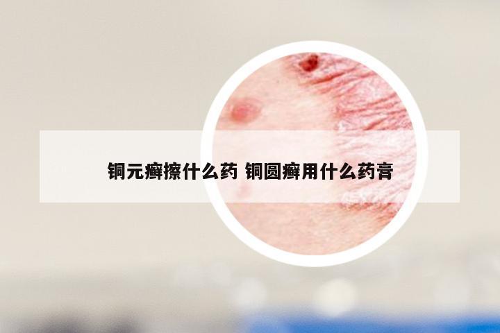 铜元癣擦什么药 铜圆癣用什么药膏