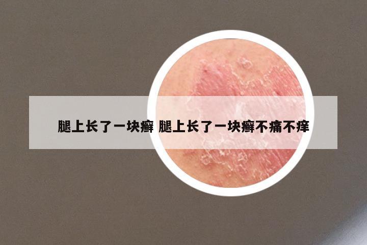 腿上长了一块癣 腿上长了一块癣不痛不痒