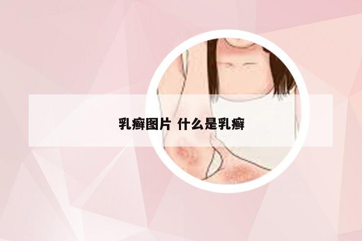 乳癣图片 什么是乳癣