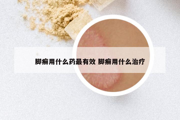 脚癣用什么药最有效 脚癣用什么治疗