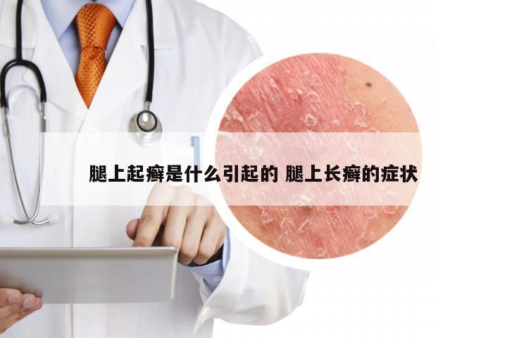 腿上起癣是什么引起的 腿上长癣的症状