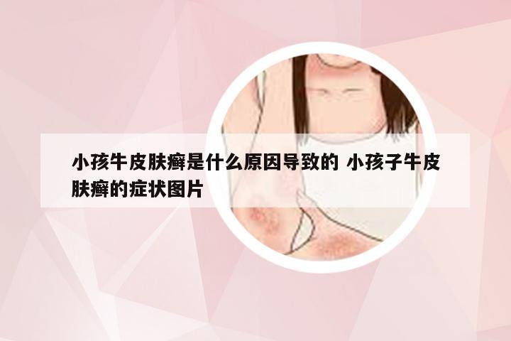 小孩牛皮肤癣是什么原因导致的 小孩子牛皮肤癣的症状图片