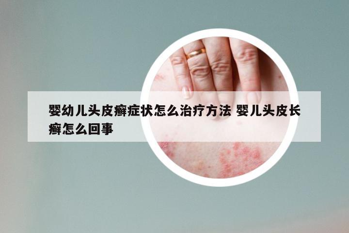婴幼儿头皮癣症状怎么治疗方法 婴儿头皮长癣怎么回事