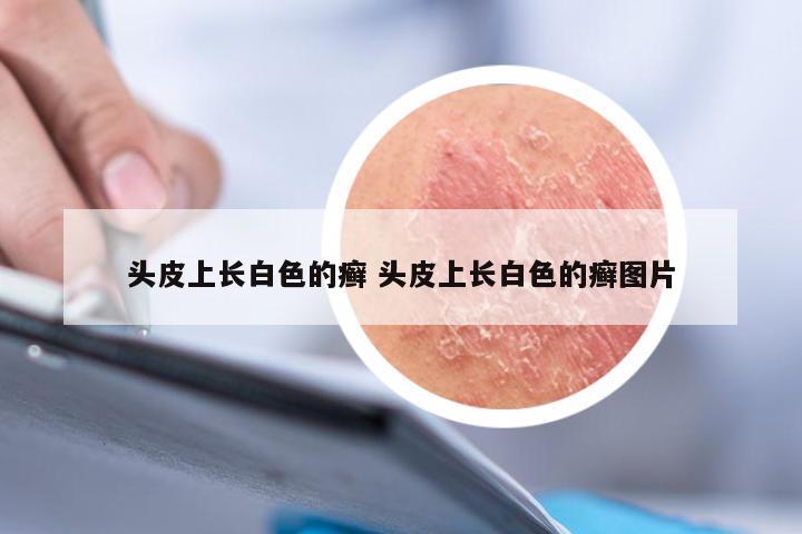 头皮上长白色的癣 头皮上长白色的癣图片