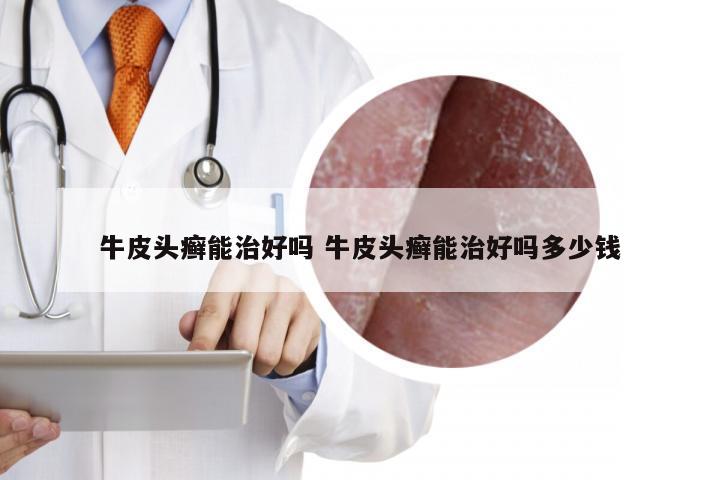 牛皮头癣能治好吗 牛皮头癣能治好吗多少钱