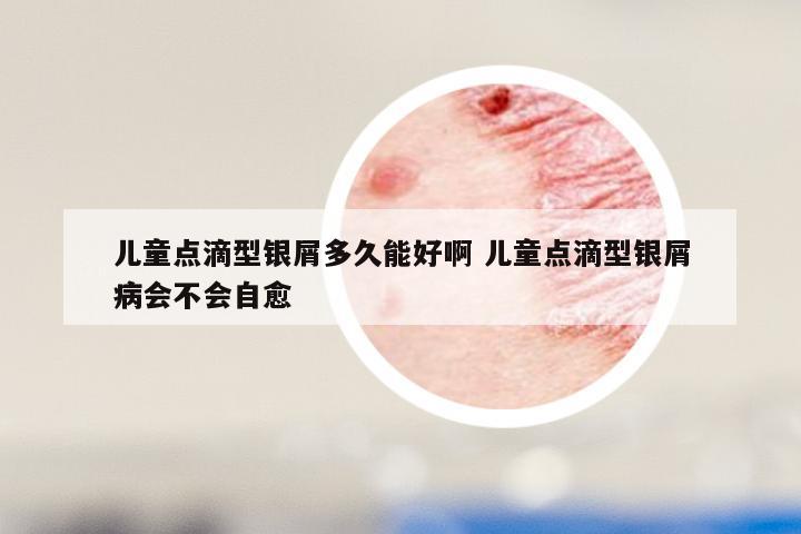 儿童点滴型银屑多久能好啊 儿童点滴型银屑病会不会自愈