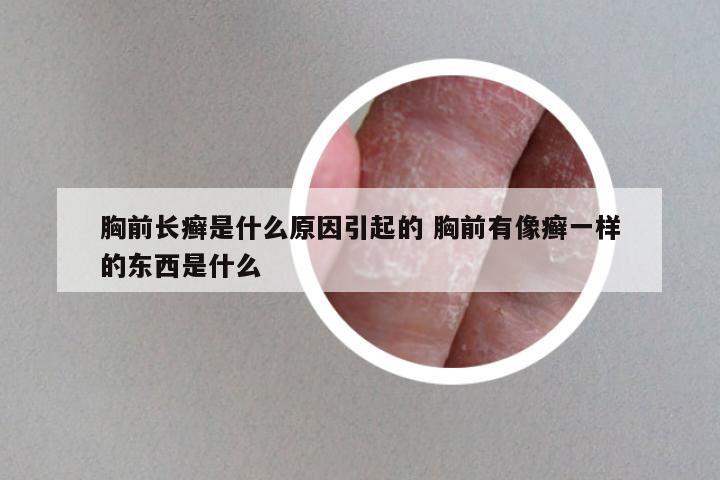 胸前长癣是什么原因引起的 胸前有像癣一样的东西是什么