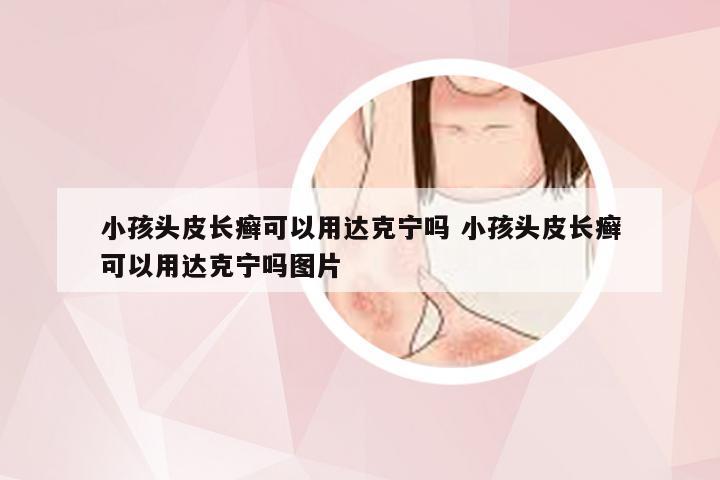 小孩头皮长癣可以用达克宁吗 小孩头皮长癣可以用达克宁吗图片