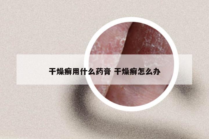 干燥癣用什么药膏 干燥癣怎么办