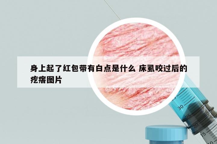 身上起了红包带有白点是什么 床虱咬过后的疙瘩图片