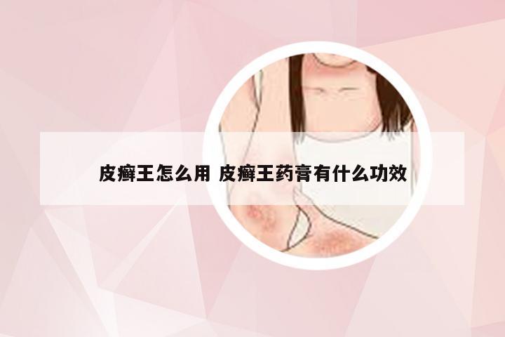 皮癣王怎么用 皮癣王药膏有什么功效