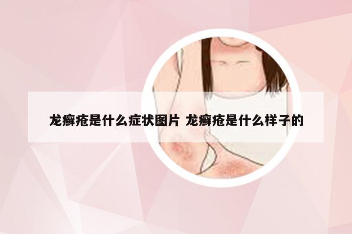 龙癣疮是什么症状图片 龙癣疮是什么样子的