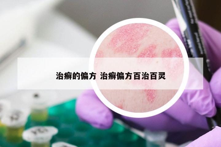 治癣的偏方 治癣偏方百治百灵