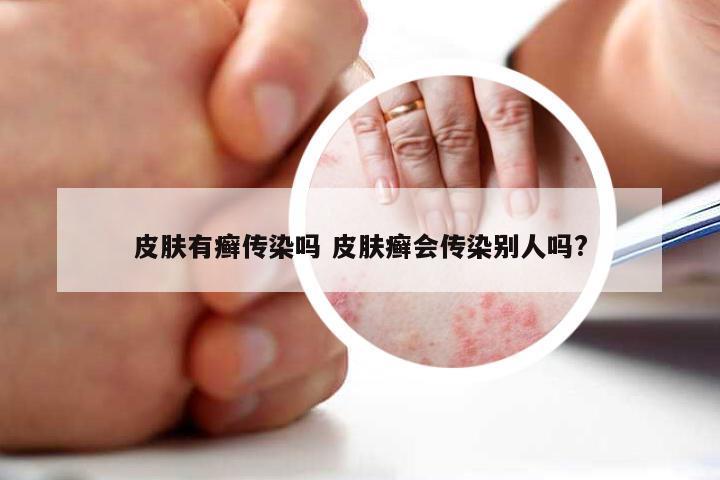 皮肤有癣传染吗 皮肤癣会传染别人吗?