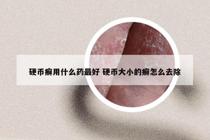 硬币癣用什么药最好 硬币大小的癣怎么去除