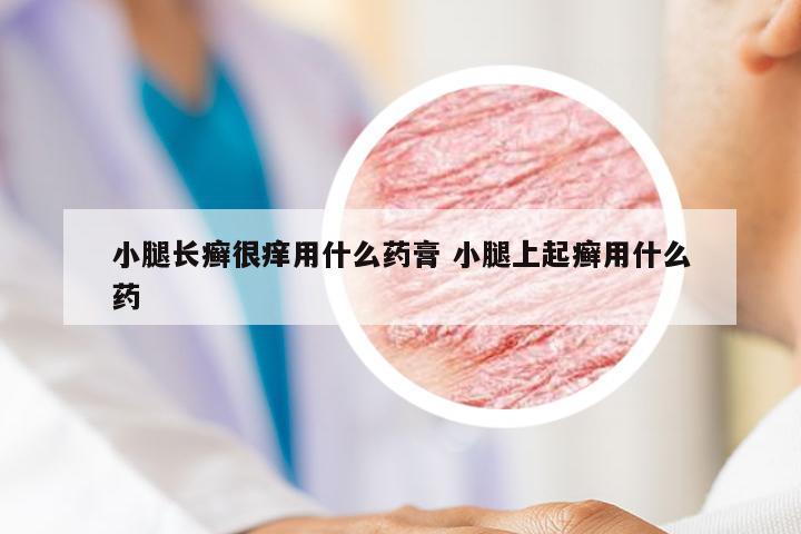 小腿长癣很痒用什么药膏 小腿上起癣用什么药