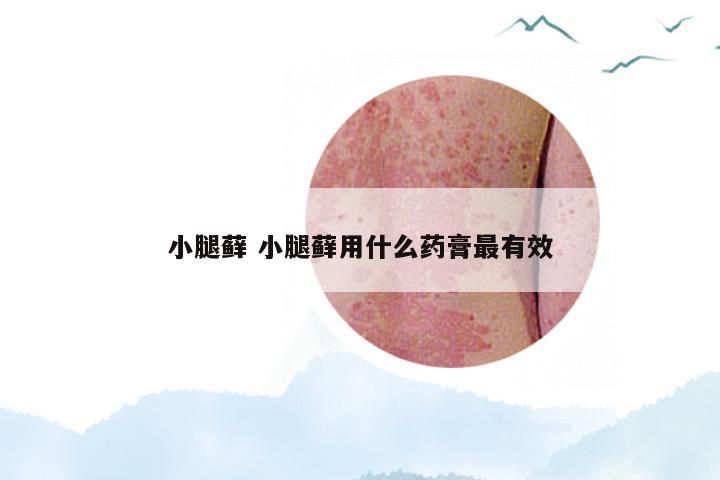 小腿藓 小腿藓用什么药膏最有效