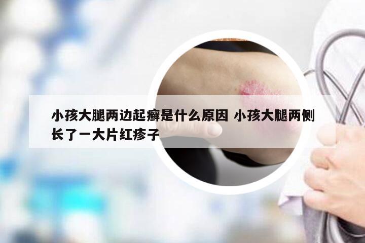 小孩大腿两边起癣是什么原因 小孩大腿两侧长了一大片红疹子